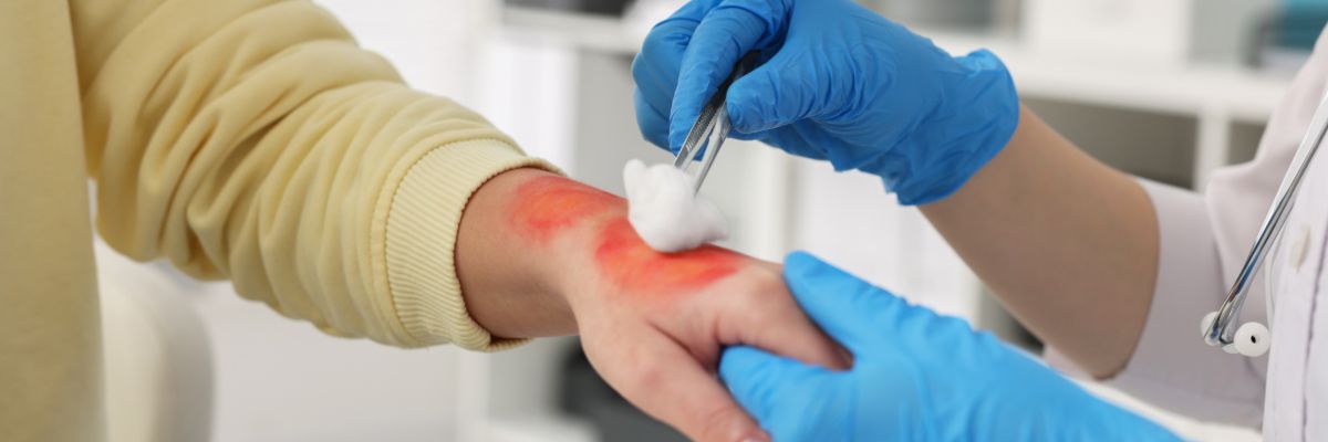 Burn Care Gels & Pads - Shop ToughWorkz